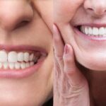 Cerebral Palsy and Its Impact