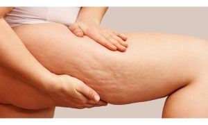 Cellulite